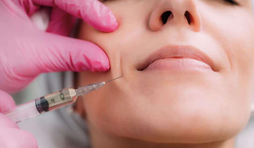 Fillers for Marionette Lines