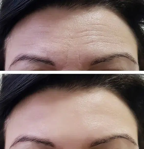 Botox for Forehead Wrinkles Before and After: What to Expect